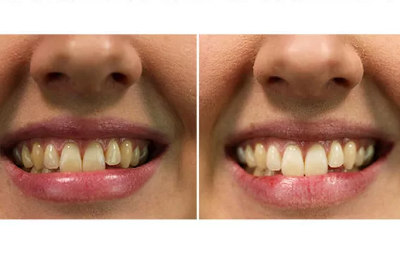 Oil pulling teeth whitening results